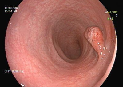 RECTAL POLYP