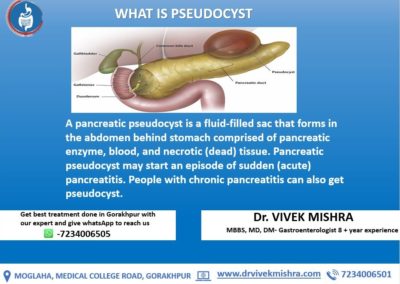 WHAT IS PSEUDOCYST