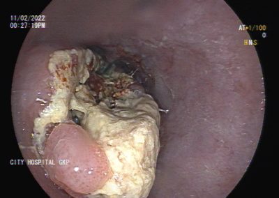 ESOPHAGEAL GROWTH (2)