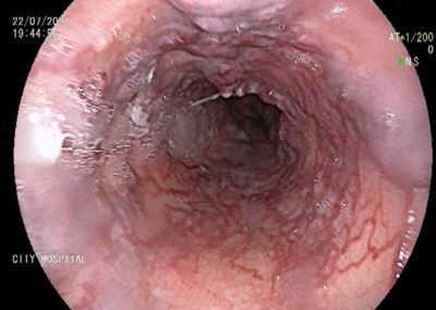 ESOPHAGEAL VARICES