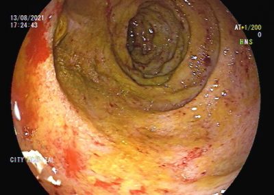 SEVERE DUODENITIS