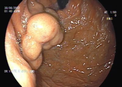 GASTRIC VARIX 2