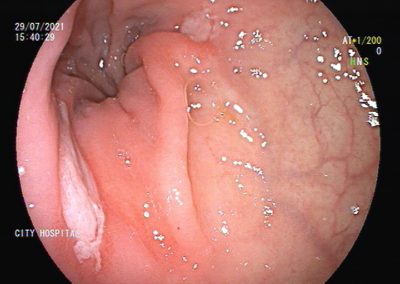 RECTAL ULCER